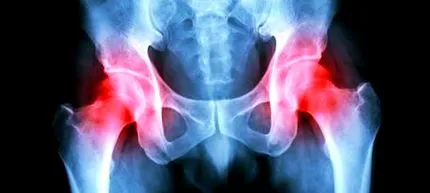 osteoarthritis
