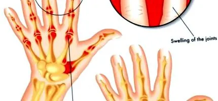 артритис дефиниција