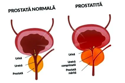 bakteriális prosztatagyulladás