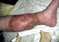 akut osteomyelitis