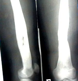 osteomyelitisben szenvedő