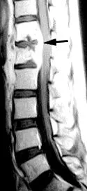 osteomyelitis