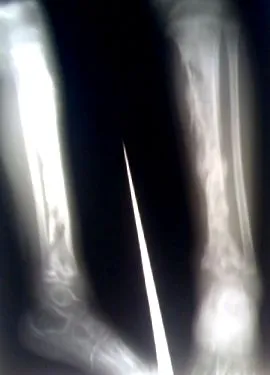 akut osteomyelitis