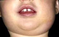 заушки