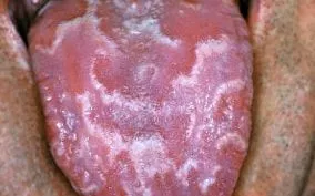 rákfekélyek candidiasis