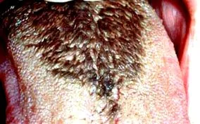 lichen planus