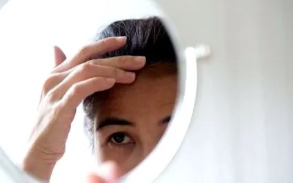 alopecia alopecia