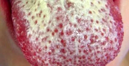 candidiasis