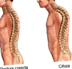 kyphosis orvosi