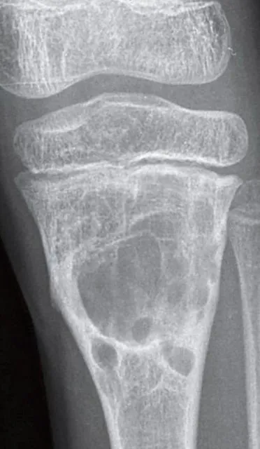 aneurysmális csontciszta