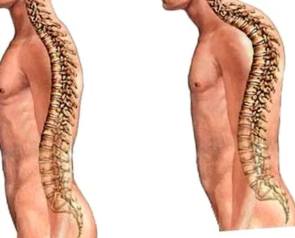 kyphosis orvosi