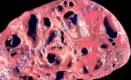 aneurysmális csontciszta