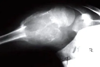 aneurysma