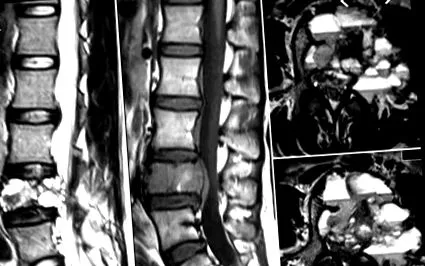 aneurysma