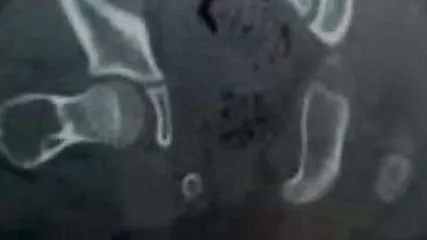 aneurysma