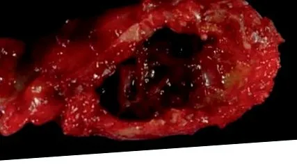 csontciszta