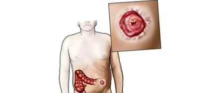 colostomia útmutató
