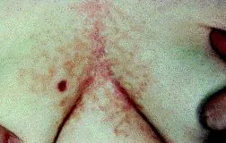 papillomatosis papillomatosis