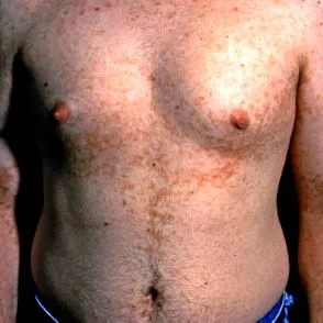 papillomatosis összefolyó