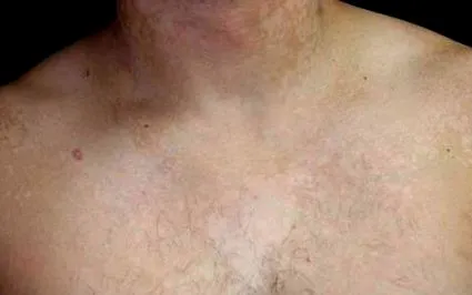 tinea splývavá