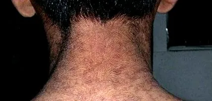 papilomatóza tinea