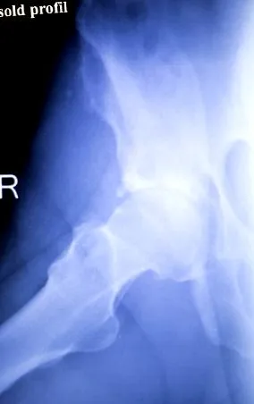 osteoarthritis osteoarthritis