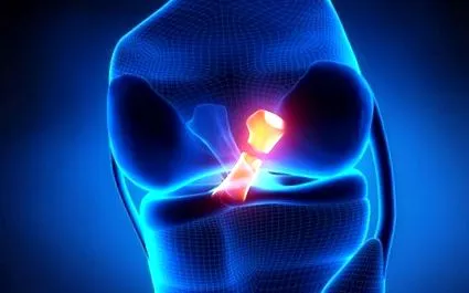 térdízület osteoarthritis