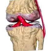 osteoarthritis osteoarthritis