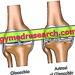 osteoarthritis mennyire
