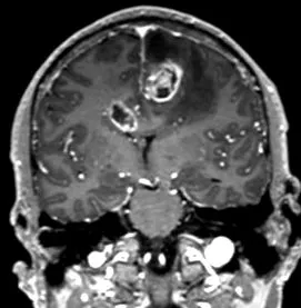 elsődleges glioblastoma általános
