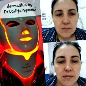 ботулински токсин