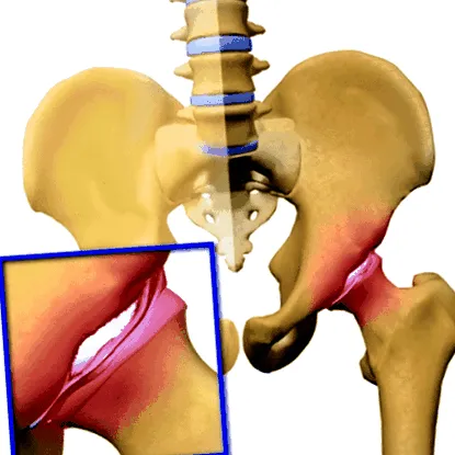 osteoarthritisének