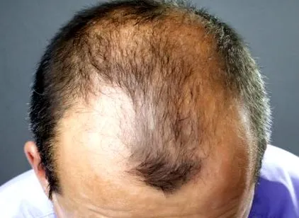 androgénfüggő alopecia