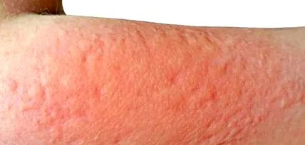 dermatitis