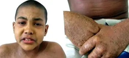 atópiás dermatitis