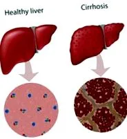 steatosis steatosis