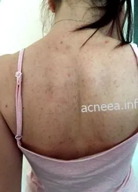 diéta