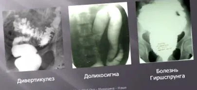 лікування