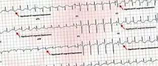 angina hrudníku