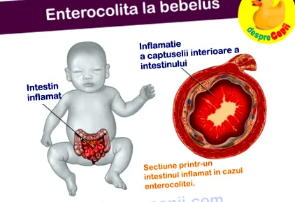 enterocolitis