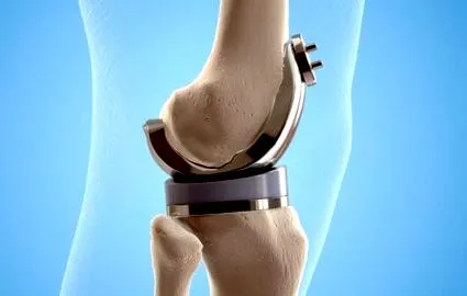 osteoarthritis