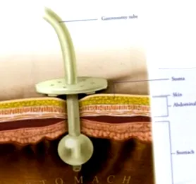 gastrostoma hányféle
