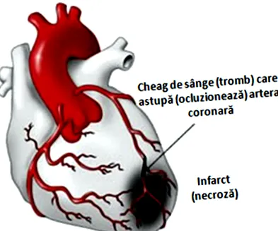 infarktus