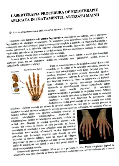 osteoarthritis