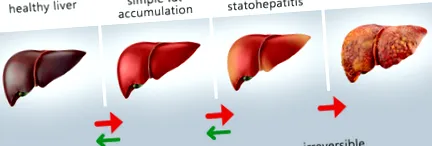 steatóza