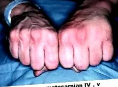 метакарпал