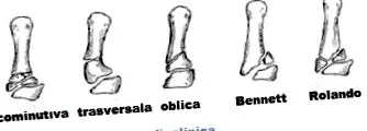метакарпал