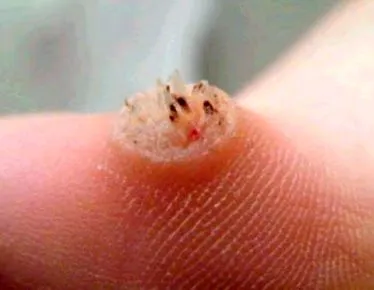 emberi papillomavírus