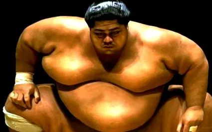 gynecomastia