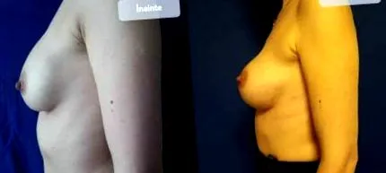 mellimplantátum felülvizsgálata